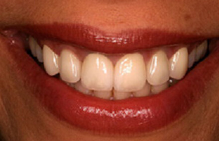 Lava crowns creating a beautiful white smile