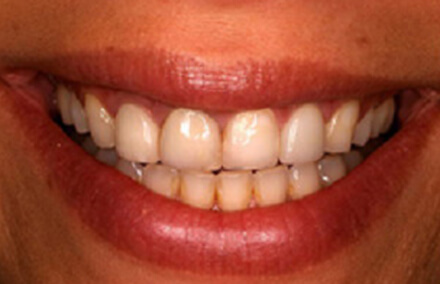 Uneven worn down yellowed teeth