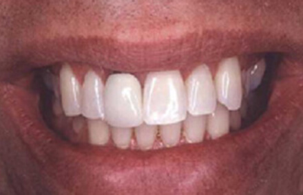 Man's smile with discolored left crown