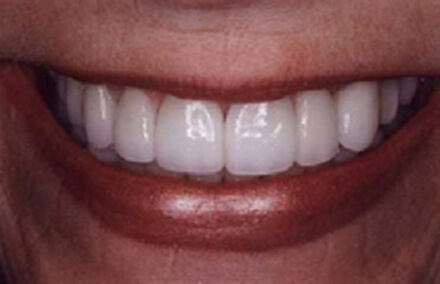 Woman's bright smile with even spacing after empress one and empress two dental crowns