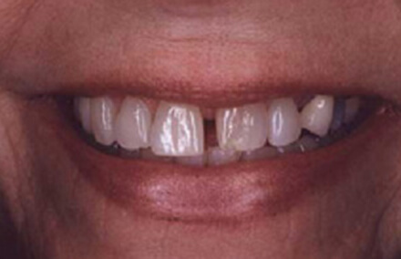 Woman's smile large gap between front teeth