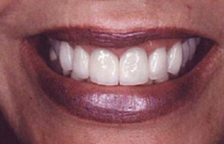 Brilliant white smile with full mouth makeover using porcelain to gold crowns and veneers