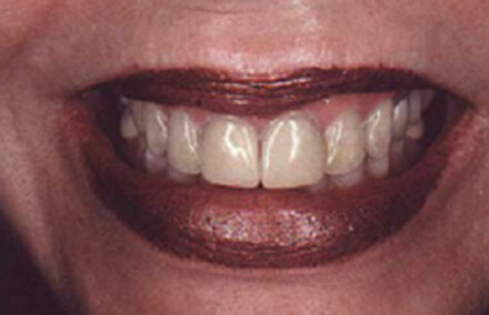 Woman with extensive staining and dental wear
