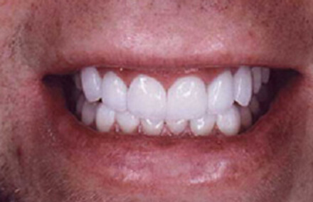 Man's smile fully repaired with natural looking empress veneers and crowns