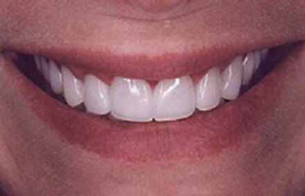 Flawless Empress crown repaired smile