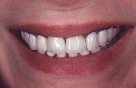Woman with over-large darkly stained teeth