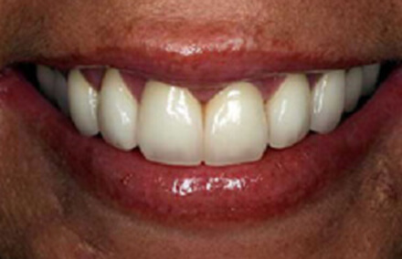 Tooth corrected with natural looking crown
