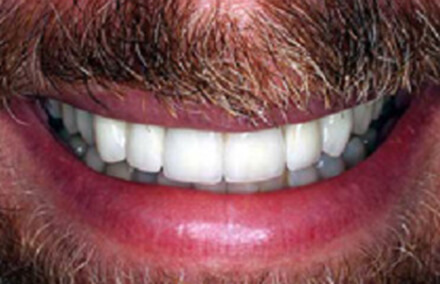 Picture-perfect smile with consistent natural coloring porcelain to gold and zirconia crowns