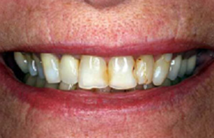 Teeth stained yellow on the sides