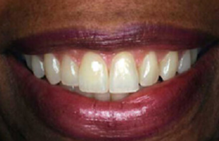 Picture-perfect smile repaired with Empress crowns