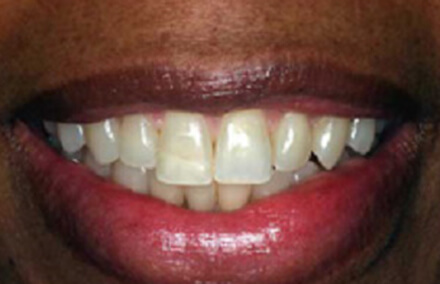 Smile with broken tooth and discoloration