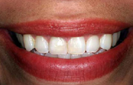 Natural looking zirconia crown tooth restoration