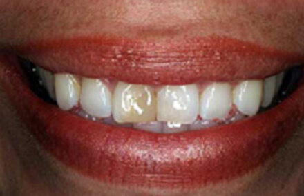 Woman's smile with discolored left tooth filling
