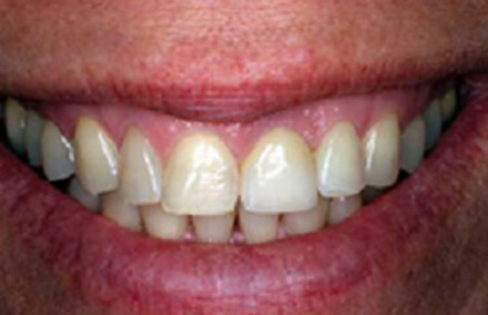 Flawlessly natural looking smile following dental implant and zirconia crown
