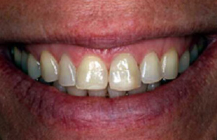 Smile with damaged left tooth