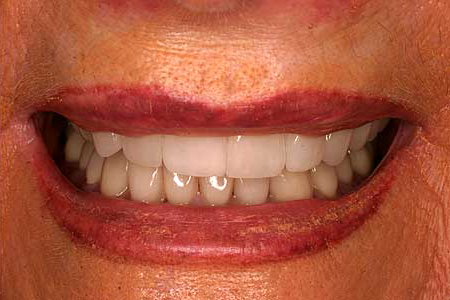 Empress veneer and zirconia and porcelain to gold dental crowns enhanced beautiful smile