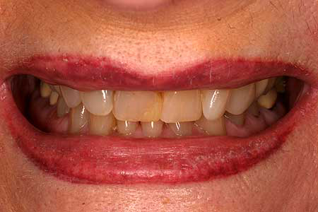 Smile with varying colored dental crowns