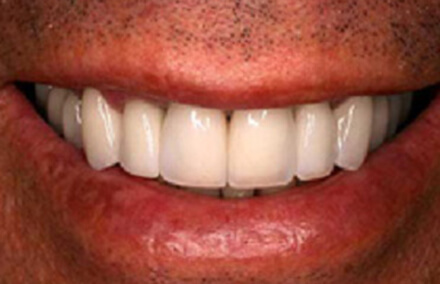 Flawlessly white evenly spaced smile after zirconia crowns