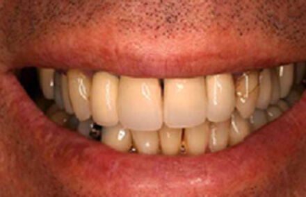 Discolored smile with damaged right tooth