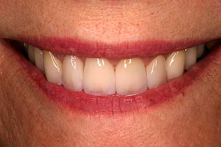 Flawlessly enhanced smile with zirconia crowns