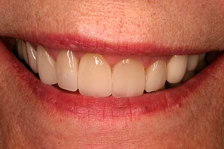 Woman's smile with unnatural looking cosmetic dentistry