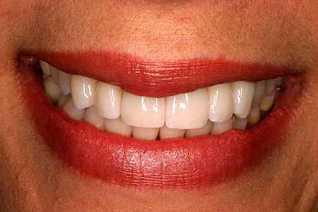 Attractive white smile with zirconia restorations