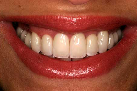 Woman with flawless smile using zirconia restoration
