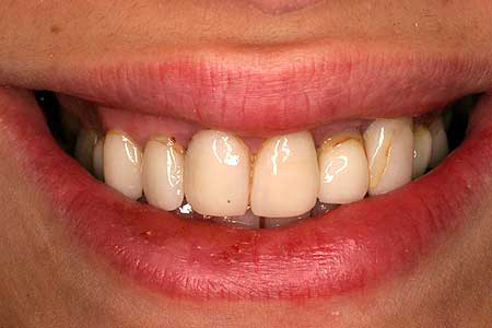 Woman with dark stains on upper right teeth