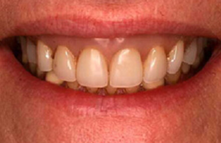 Yellowed teeth and unnatural looking denture base