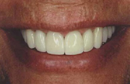 Woman's teeth after porcelain crowns and veneers