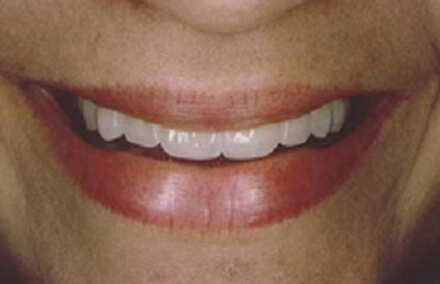 Woman with white properly aligned teeth after porcelain dental restorations