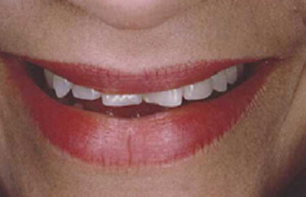 Woman's crooked worn teeth
