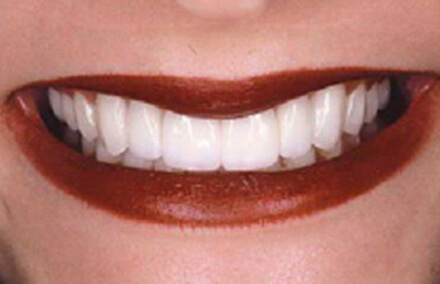 Woman's smile with even spacing between teeth after empress porcelain veneer crowns and onlays