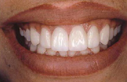 Woman with perfectly aligned front teeth after porcelain veneer crowns