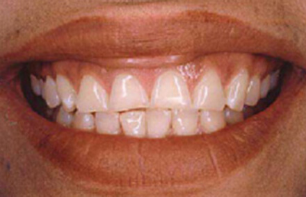 Woman with front teeth that do not touch