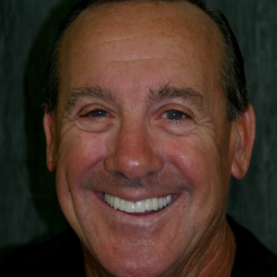 Close up of dental patient smiling after tooth colored filling treatment