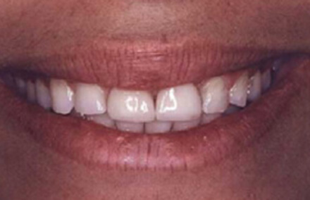 Woman with stubby misshapen teeth
