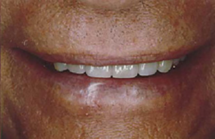 Man's smile transformed with six porcelain veneers