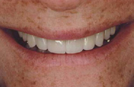 Woman with rebuilt teeth smiling