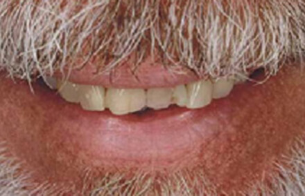 Man with crooked and chipped front teeth