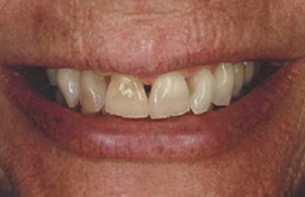 Woman with misshapen gapped and stained teeth