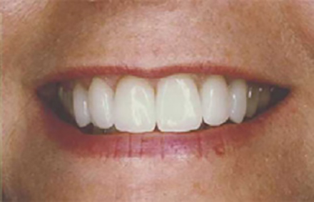 Woman's smile repaired with porcelain crowns and veneers