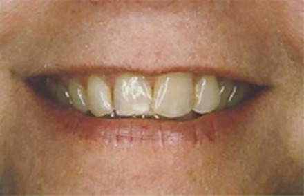 Woman's smile with discolored and worn teeth