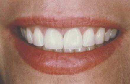 Woman's teeth corrected after Empress porcelainrestoration makeover