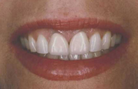 Woman's front teeth sticking out
