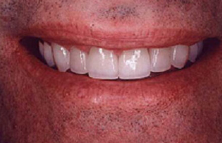 Man's smile with twelve tooth porcelain crowns and porcelain to gold bridge makeover