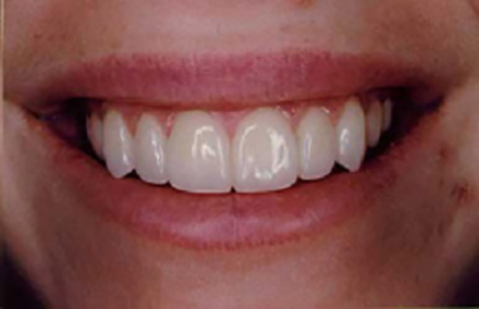 Girl's flawless smile after porcelain veneers are placed