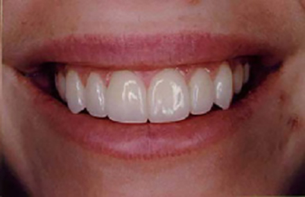 Girl with flawless smile after porcelain veneers are placed