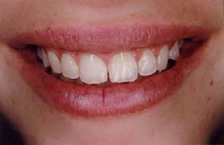 Girl with flawed smile after braces are removed