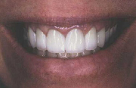 Woman after corrected smile makeover with Empress two all porcelain crowns